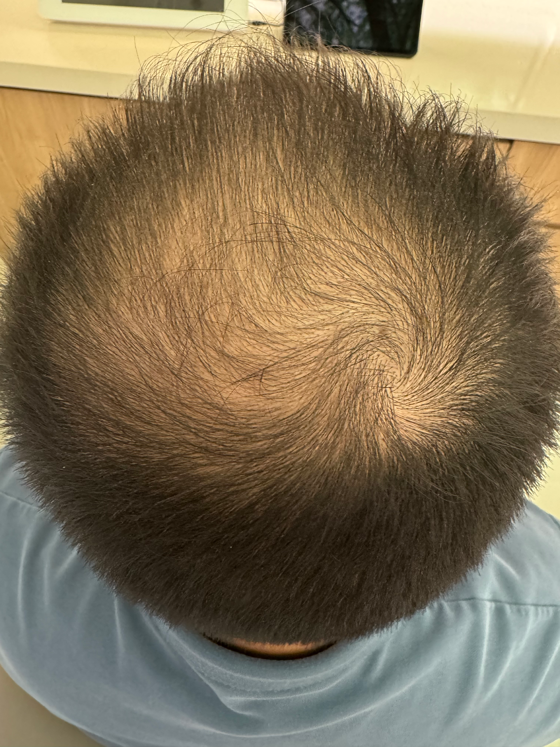 雄性激素脱发-5131.png
