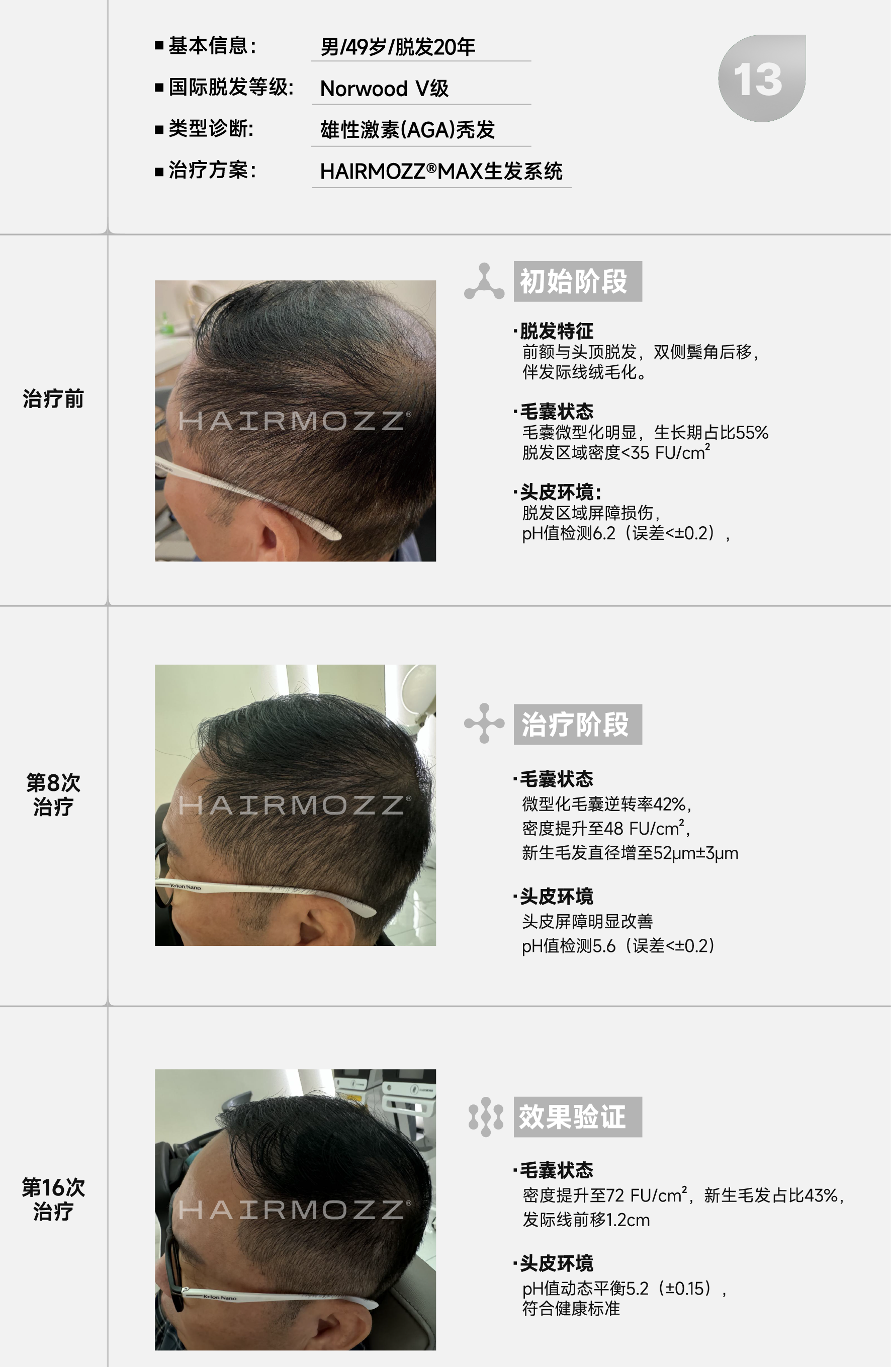 HAIRMOZZ生发案例