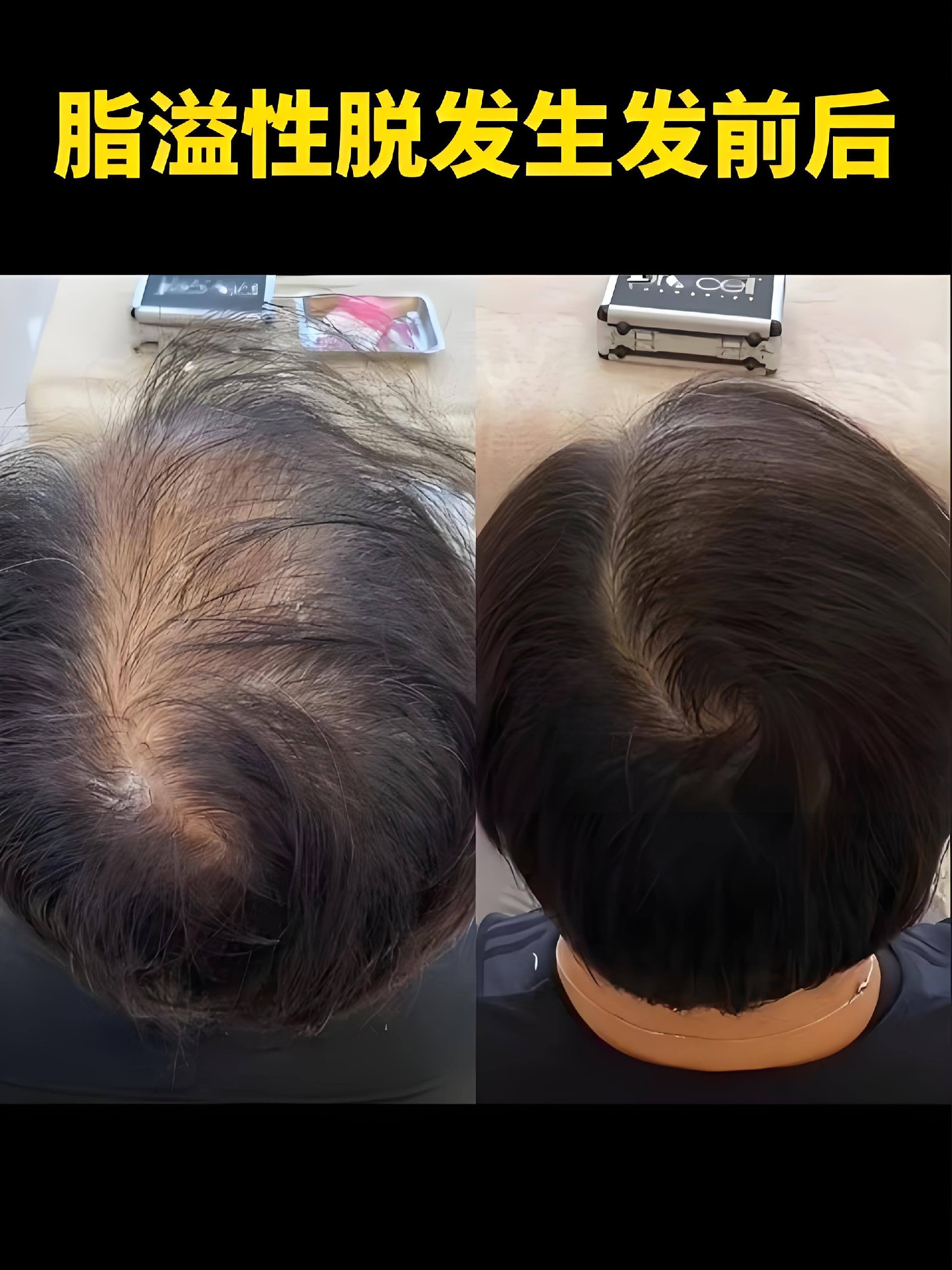 脂溢性脱发生发前后(1).jpg