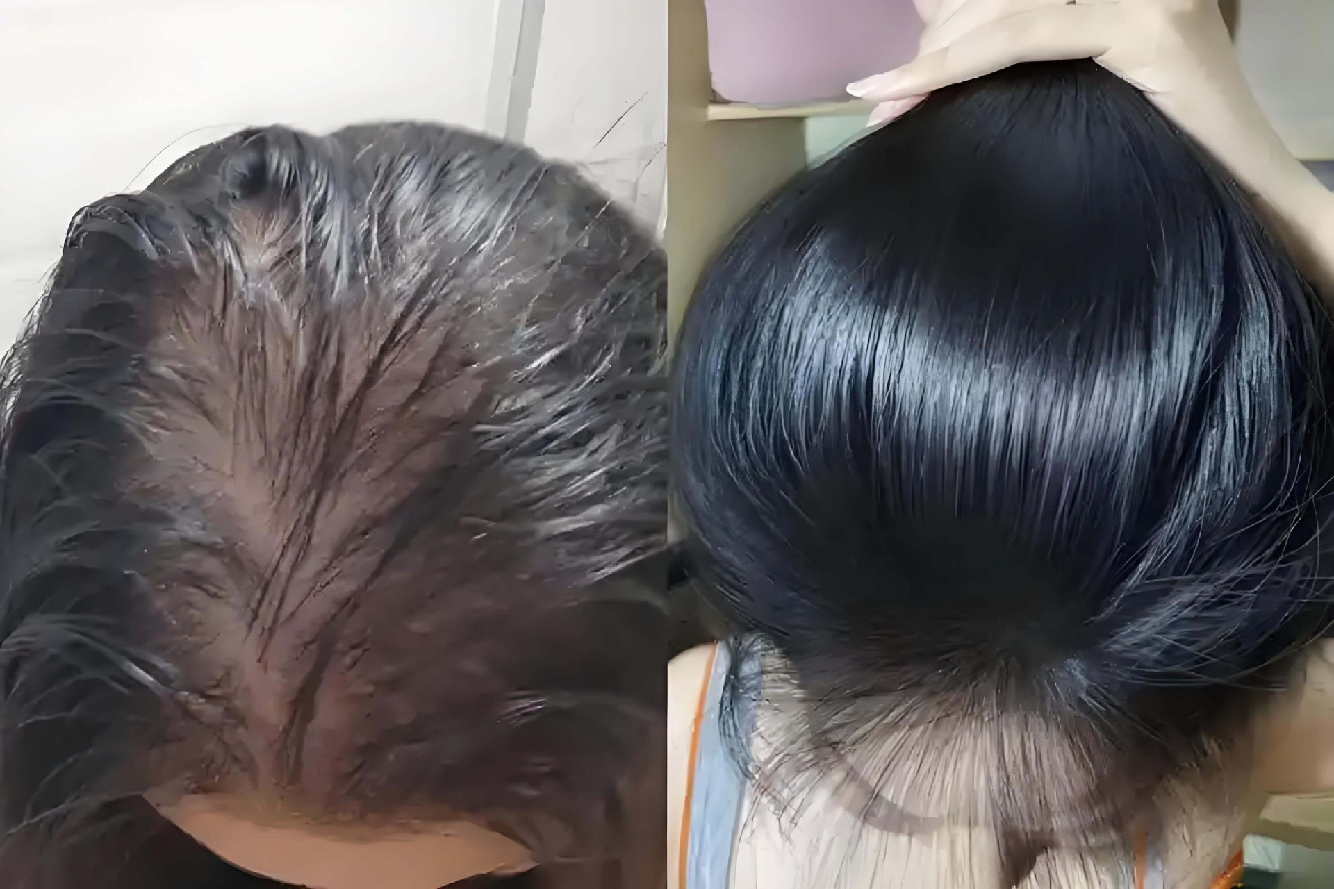 脂溢性脱发（女）(1).jpg