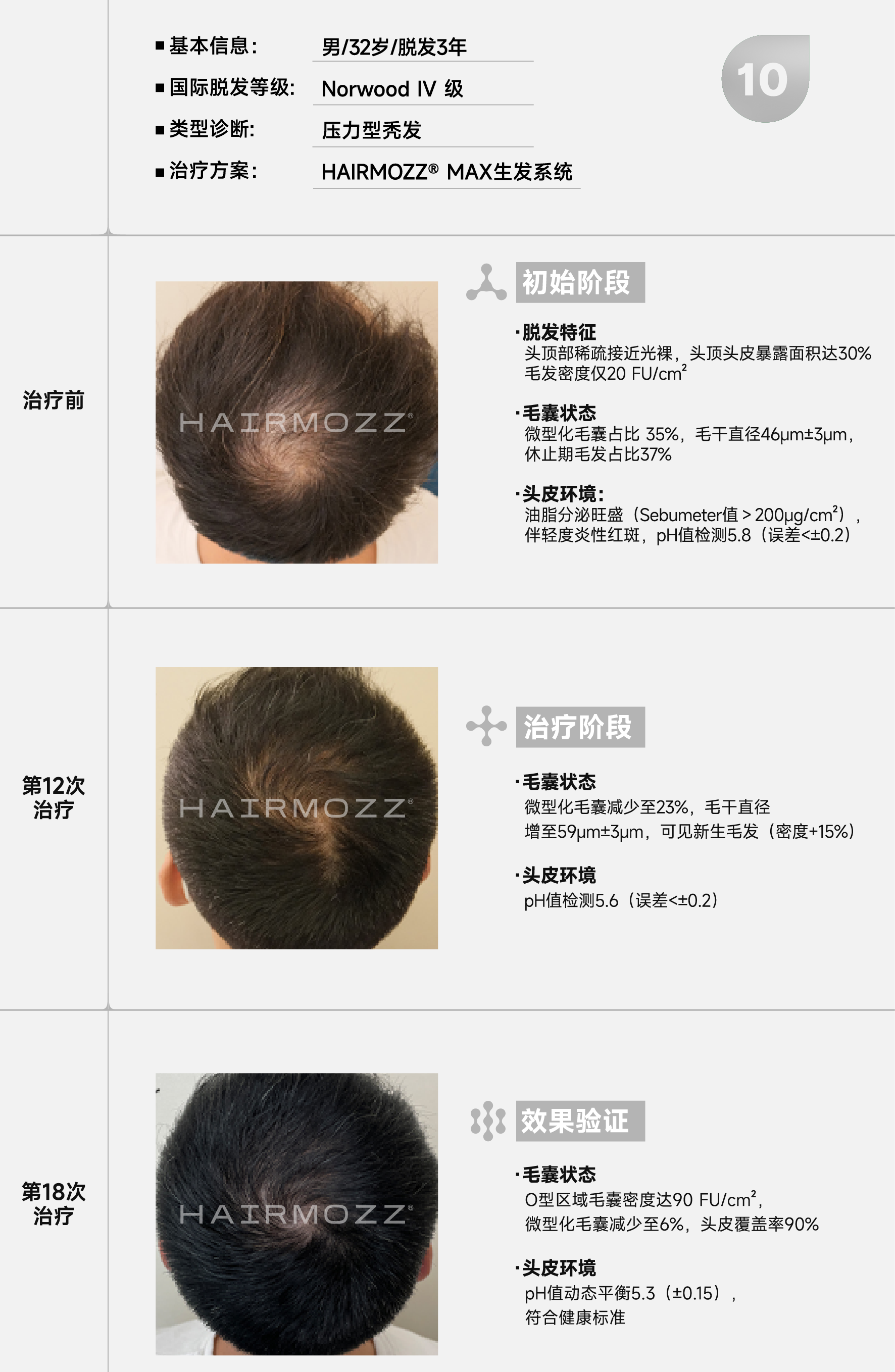 压力型脱发