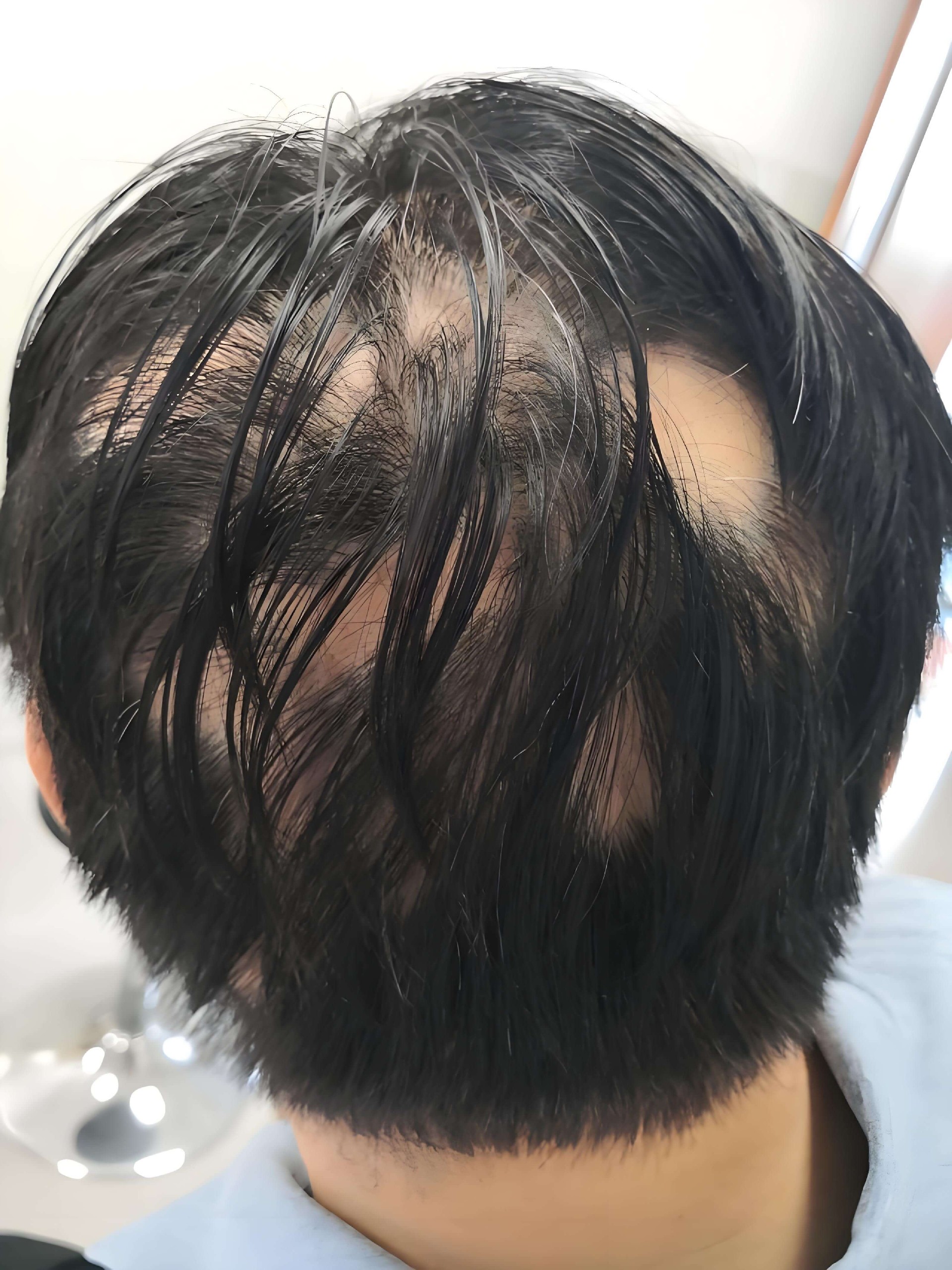 斑秃.jpg