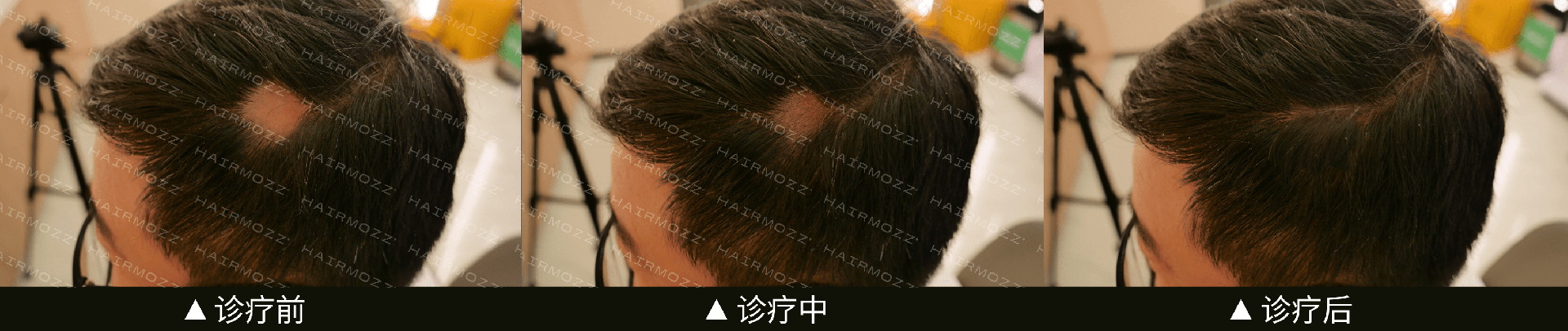 HAIRMOZZ斑秃治疗图.png