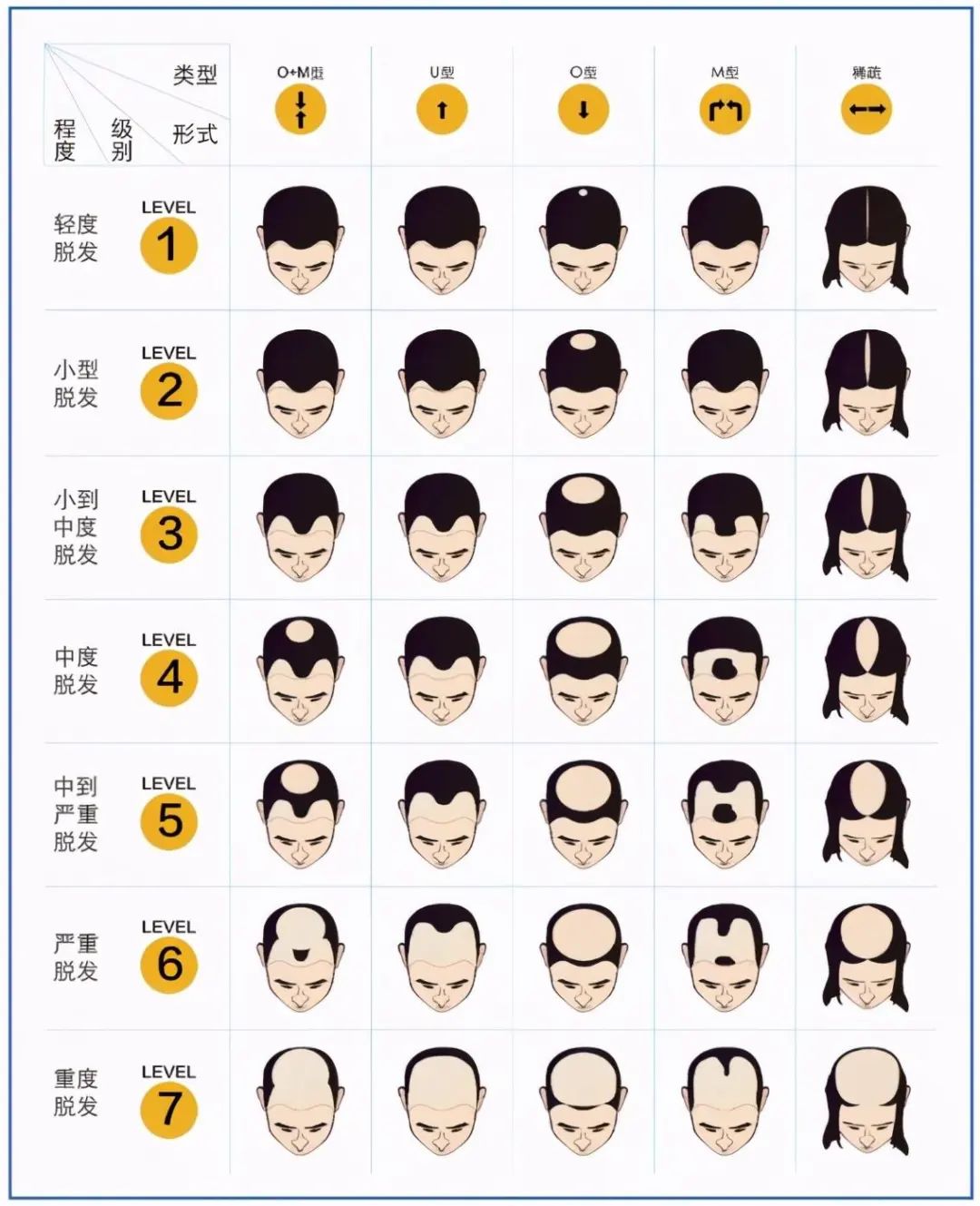 脱发等级图.jpg