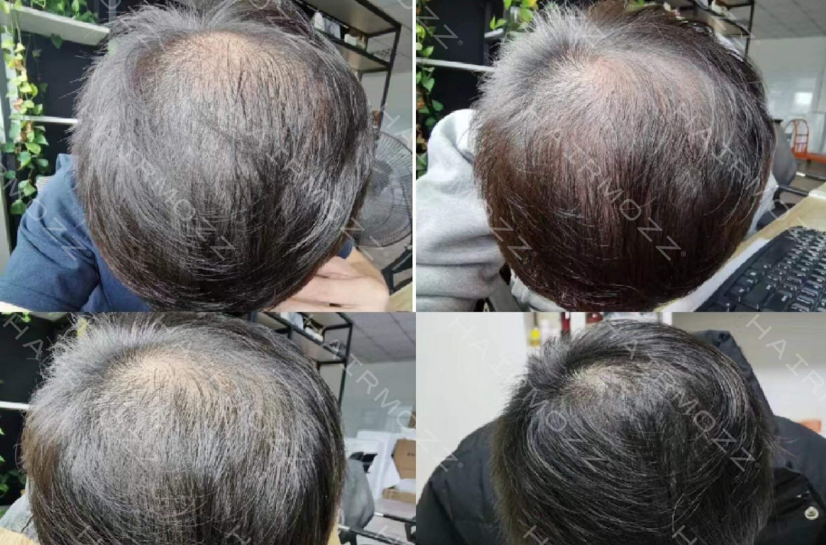 雄激素O型秃发对比图.jpg