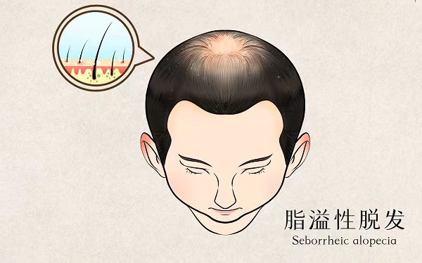 脂溢性脱发.png